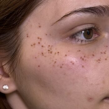 faux freckle tattoo uk leeds england