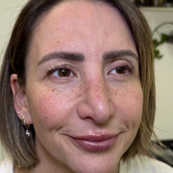 Healed faux freckles uk leeds england